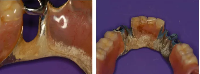 Figure 1.6. Accumulation de plaque                 Figure 1.7. Plaque dentaire recouvrant le                                 dentaire localisée  sous le crochet