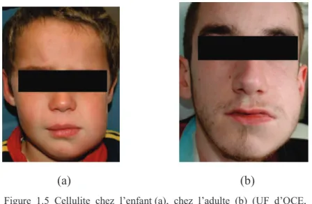 Figure  1.5  Cellulite  chez  l’enfant (a),  chez  l’adulte  (b)  (UF  d’OCE,  service d’Odontologie, CHRU Brest) 
