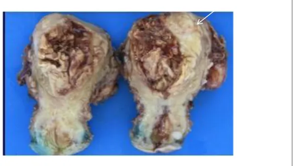 Figure 2: Aspect microscopique du carcinome endométrioïde 