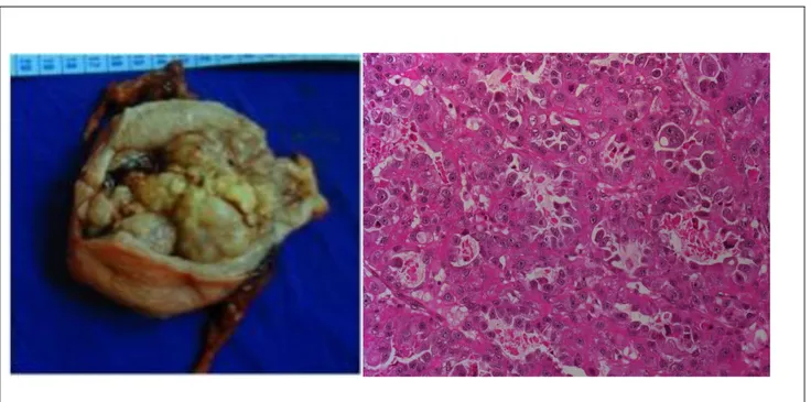 Figure 3: Aspect macroscopique et histologique d'un carcinome à cellules claires  A  gauche :  Aspect  macroscopique  -  A  droite :  Coupe  histologique  (coloration  HES,  agrandissement  x  200) :  prolifération  tumorale  infiltrante  avec  de  multipl