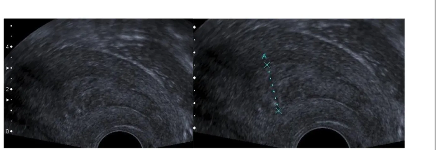 Figure 6 : Aspect échographique du cancer de l'endomètre chez une patiente ménopausée  A gauche: lésion échogène, hétérogène avec des contours réguliers - A droite: lésion mesurée à  11mm