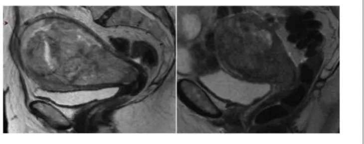 Figure 11: Lésion endométriale envahissant la séreuse 