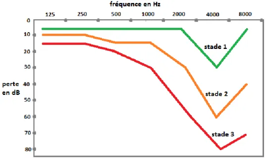 Figure 25 : Audiogrammes types du traumatisme sonore progressif  D’après Cottin-Colle, 1989 (68) 