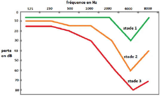 Figure 25 : Audiogrammes types du traumatisme sonore progressif  D’après Cottin-Colle, 1989 (68) 