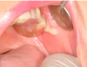 Fig. : 1.8. Ecoulement purulent à lostium du canal de Sténon (Boisramé-Gastrin S.) 