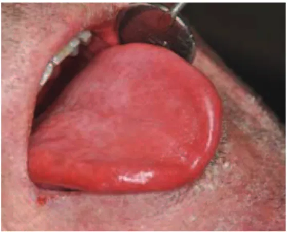 Fig. : 1.13. Langue dépapillée, fissurée (Boisramé-Gastrin S)    