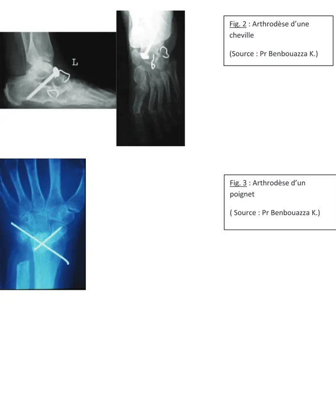 Fig. 2 : Arthrodèse d’une cheville