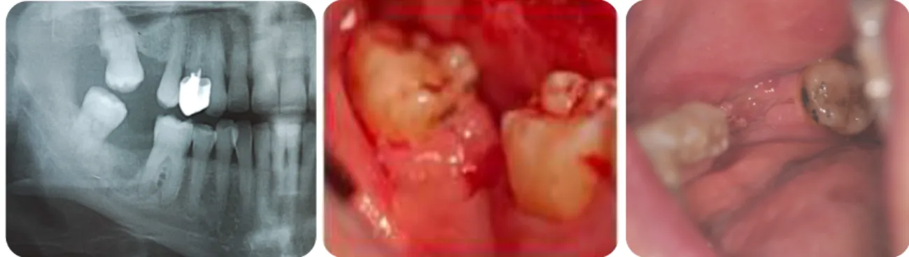 Figure 3.5 Traitement médico-chirugical d’une ostéonécrose induite par les BP évoluant sous une  muqueuse saine, ablation du foyer de nécrose, application de PRF, résultats à 1mois
