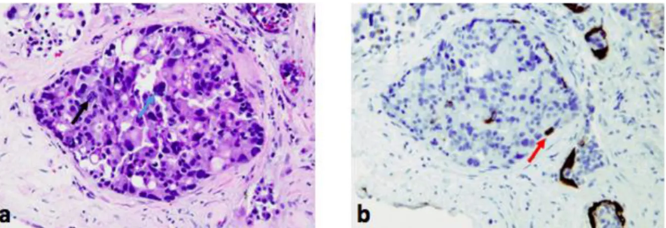 Figure 11 Carcinome intra-ductal; a: HES flèche noire: atypie nucléaire; flèche bleue: figure mitotique; b: 