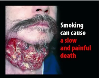 Figure 2 : Exemple de prévention primaire de lutte contre le tabagisme en grande  Bretagne (nouvelobs.com) 
