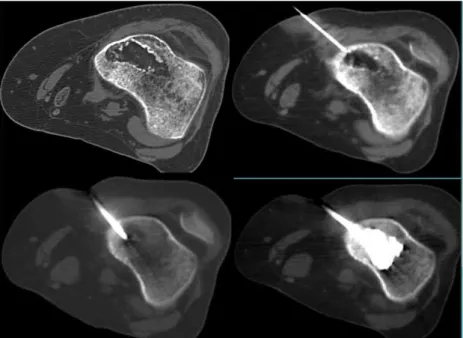 Figure 8 et 9 : Exemple d’une cimentoplastie percutanée d’une MO ostéolytique du  cotyle et d’une lésion lytique de l’épiphyse distale du fémur (service de radiologie 