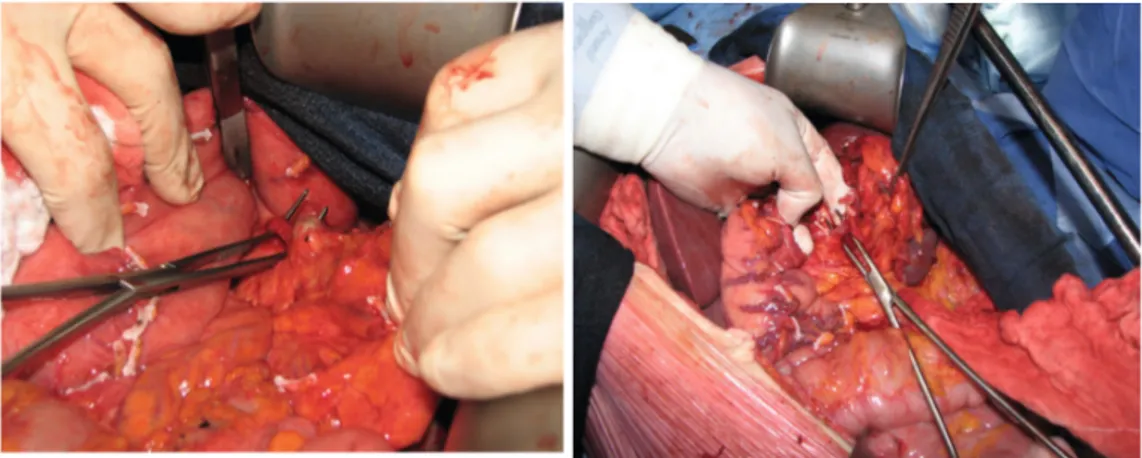 Figure 9 : ligature de l’artère splénique (photo de gauche) et de la veine splénique (photo de droite)  par abord antérieur