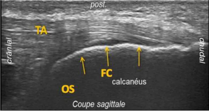 Figure 2 : Enthèse du tendon d’Achille en échographie. On visualise le tendon (TA), le fibrocartilage  sous la forme d’une fine ligne hypoéchogène et l’os sous-chondral