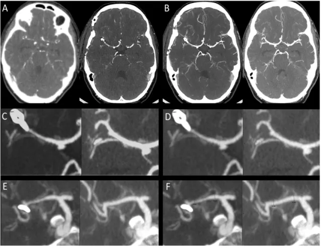 Figure 1. Cerebral vasospasm (CVS) computed on CTA.  Initial (pre-CVS) and per- per-CVS CTA (A) were co-registered in a multiplanar reconstruction with 2 to 5 mm thin  sections on maximal intensity projection (MIP) (B)