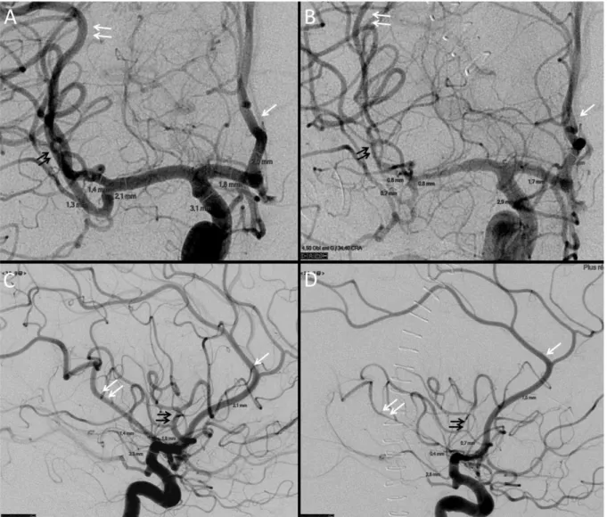 Figure 2. Cerebral vasospasm (CVS) computed on DSA.  Initial frontal (A) and lateral  (C) angiogram of internal carotid artery were compared to per-CVS angiogram (B, D)