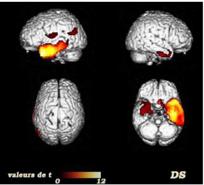 Figure 1 : Profil d’hypoperfusion‏cérébrale‏chez‏les‏patients‏avec‏une DS 