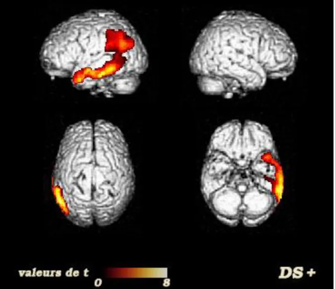 Figure 3 : Profil‏d’hypoperfusion‏cérébrale‏chez‏les‏patients‏avec‏une‏DS‏et‏un‏