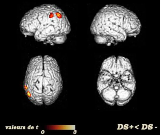 Figure  4 :  Comparaison  directe  des  profils  perfusionnels  des  groupes  DS+  et  DS- 