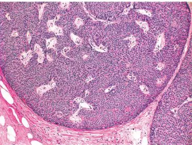 Figure 9: Carcinome papillaire solide : deux nodules composés d’une prolifération de cellules  épithéliales ovoïdes, au sein de laquelle des axes fibro-vasculaires sont visualisés 