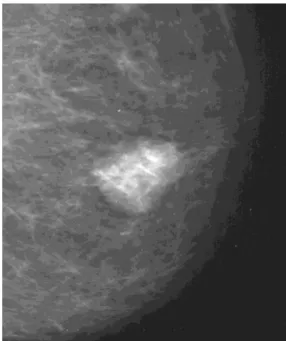 Figure 12:Mammographie de face :  masse rétroaréolaire de contours circonscrits  correspondant à un papillome bénin à la biopsie (Brookes et al 2008) 