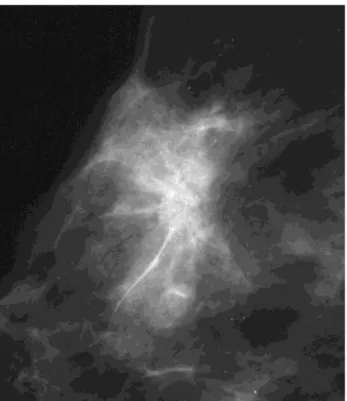 Figure 15: Cliché mammographique de profil : Masse de contours non circonscrits de 3cm avec  distorsion architecturale correspondant à un carcinome papillaire invasif (Brooke et al 2008)