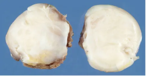 Figure 2 : aspect macroscopique d’une tumeur desmoïde 