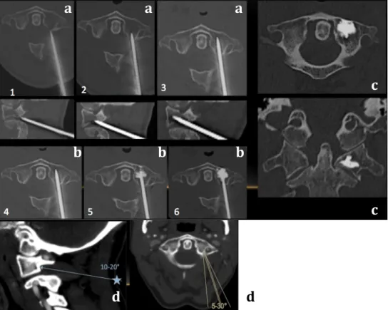 Figure 5 : Approche postérolatérale 