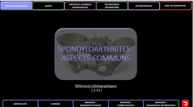 Figure 4 : Exemple de fiche : SPONDYLOARTHRITES : ASPECTS COMMUNS 
