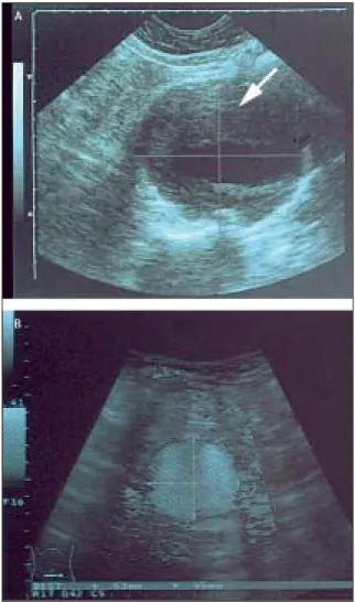 Figure 1: Ultrasonography of an infrarenal aortic aneurysm 