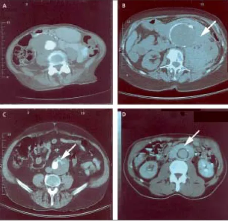 Figure 2: CT images of abdominal aortic aneurysms