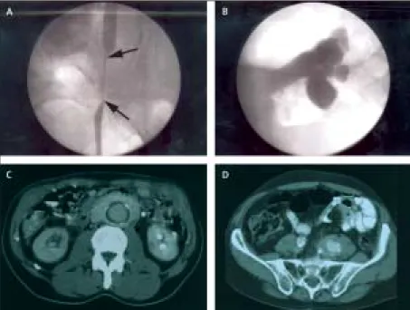Figure 4: Ureterohydronephrosis associated with abdominal aortic aneurysm 