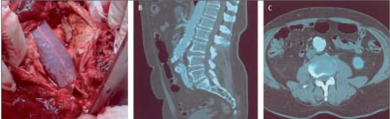 Figure 9: Potential issues of endovascular aneurysm repair