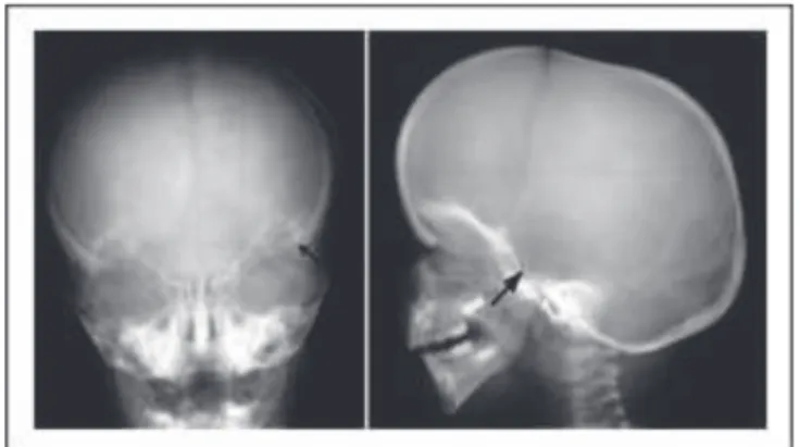 Figure 2. Anomalie radiologique : selle turcique en « J » (1). 