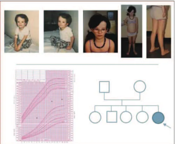 Figure 14. Phénotype du patient 1 de gauche à droite : à l’âge de 8ans, puis 16 ans, en haut