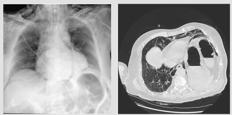 Figure 1. Chest radiograph showing a significant pneumomediastinum with sub- sub-cutaneous emphysema in the cervical and axillary regions