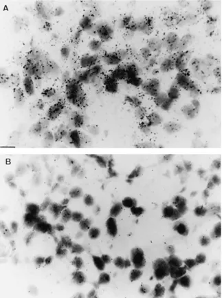 Figure 3 In situ hybridization for dopamine D2 receptor mRNA in the silent corticotroph adenoma (microautoradiography)