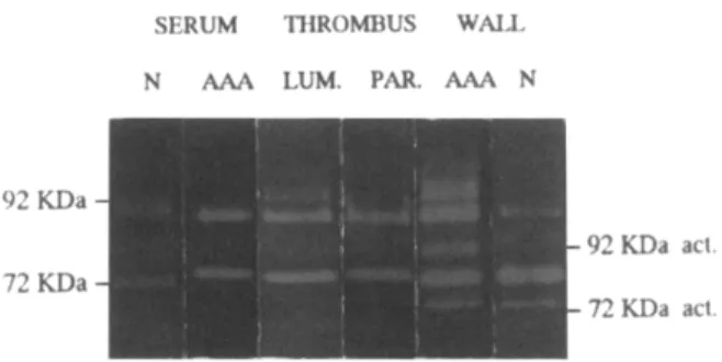 Fig.  1.  Representative  example  of  MMP 2  and  MMP 9  activity under latent (92 and 72 kDa) or processed (92 and  72 kDa act)  forms measured by zymography in serum and  vessel wall (WALL)  extracts of normal aorta  (N) and AAAs