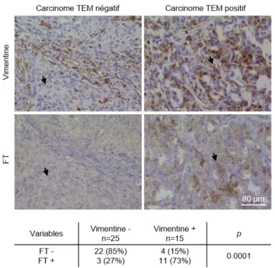 Figure 14 : Images microscopiques illustratives du marquage vimentine et FT dans la banque de  tumeurs mammaires triple négatives