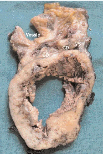 Fig. 3. Aspect macroscopique de la pièce d’exérèse abdomino- abdomino-pelvienne (coupe transverse après fixation au formol)