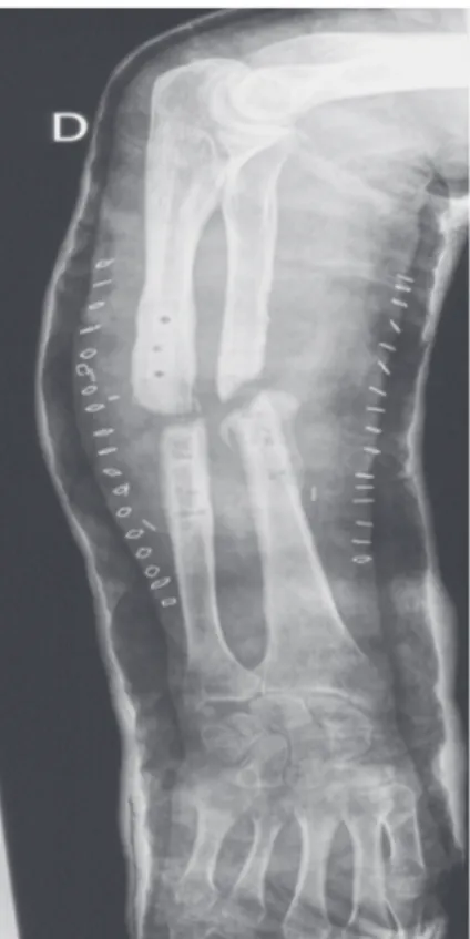 Figure 2 : Pseudarthrose atrophique. L’examen de cette radiographie d’avant- d’avant-bras montre un défect majeur accompagné d’une sclérose des 4 berges  osseu-ses.