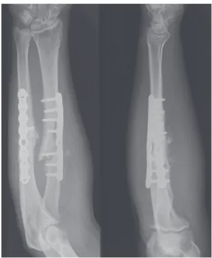 Figure 5A : Evolution clinique favorable d’une pseudarthrose des deux os  de l’avant-bras chez un patient de 42 ans dont la fracture initiale était traitée  par Metaizeau, puis reprise à 1 an par ostéosynthèse par plaque, greffe de  banque et BMP
