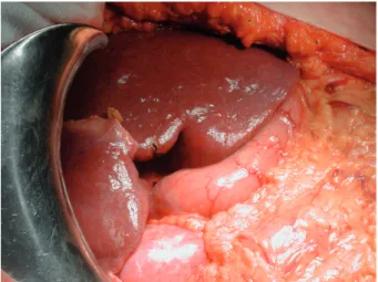 Figure  8  :  Image  peropératoire  démontrant  l’hypertrophie  du  foie  gauche  après embolisation de la veine porte droite..