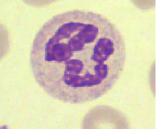 Figure 3 : neutrophile hypersegmenté sur déficit en B12. 