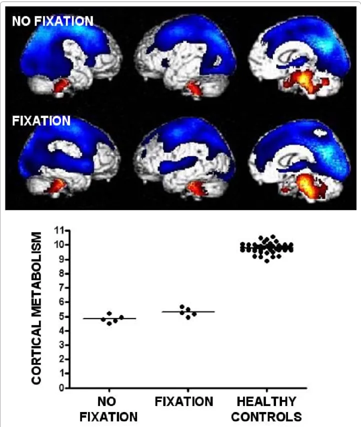 Figure 1 Brain areas with impaired cerebral glucose metabolism (blue) in patients in a vegetative state (without fixation) and in patients  with visual fixation but showing all other clinical features of the vegetative state