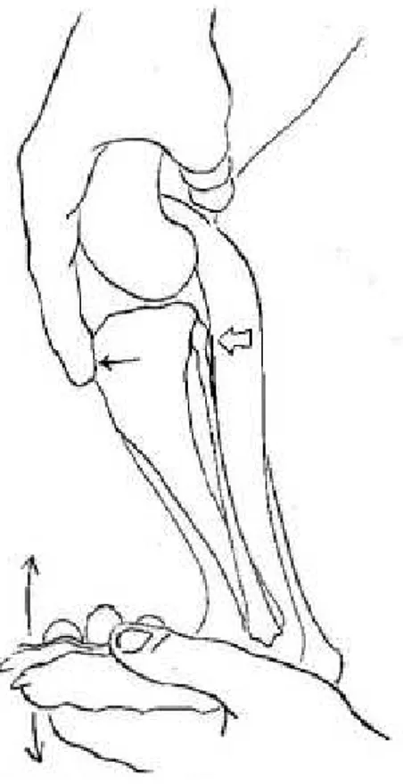 Figure 15. Mise en évidence du signe du  tiroir. Il doit être réalisé en extension et  en flexion de 30°