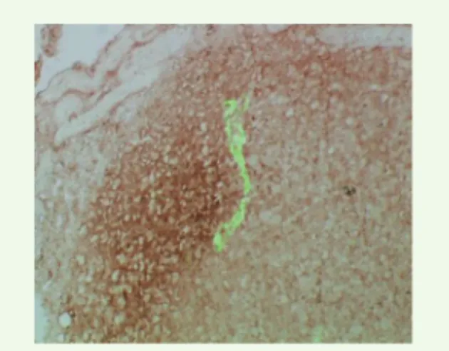 Figure 1. Lyve-1/Pimonidazole. Immunodétec- Immunodétec-tion des vaisseaux lymphatiques (Lyve-1) (en  vert) en périphérie des zones d’hypoxie  (Pimo-nidazole) dans les tumeurs capan-1.