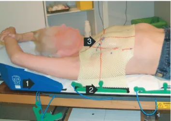 Fig. 2. Needle-guiding template bridge. A clear, yellow thermo- thermo-plastic sheet is molded around the breast