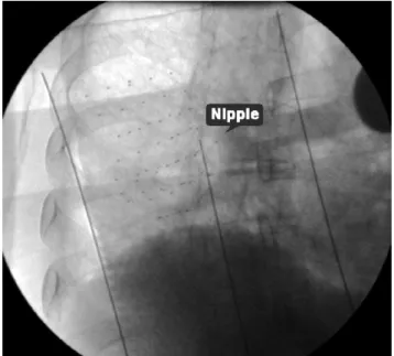 Fig. 4. Postimplant fluoroscopic image obtained after removal of the thermoplastic sheet showing the implanted strands