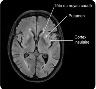 Figure 1. Aspect de l’IRM cérébrale montrant en  séquence FLAIR, outre la leucoencéphalopathie 
