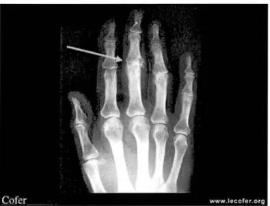 Figure 3.  Pincement articulaire 